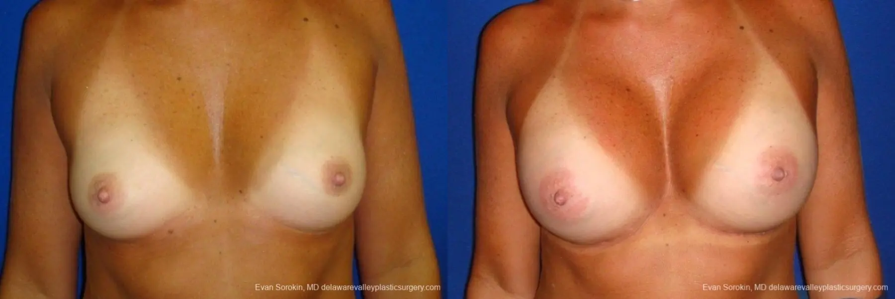 Philadelphia Breast Augmentation 8775 - Before and After 1