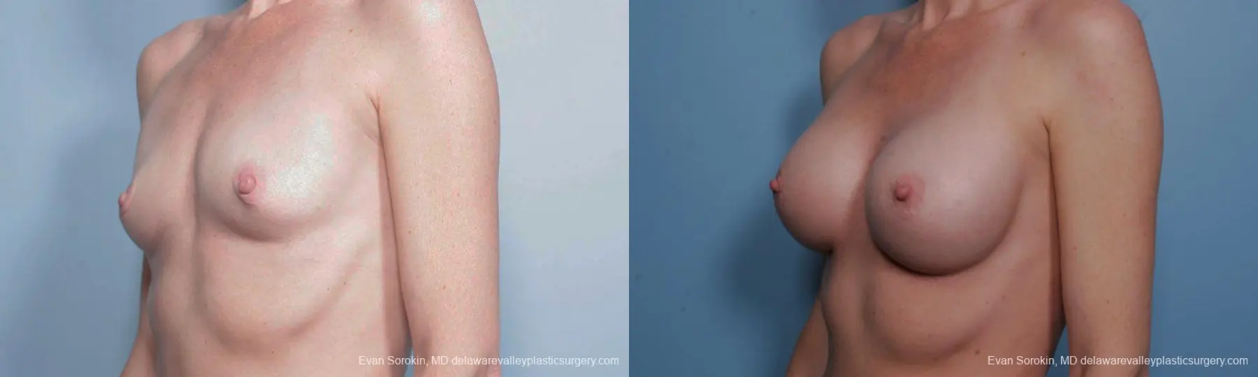 Philadelphia Breast Augmentation 9459 - Before and After 4