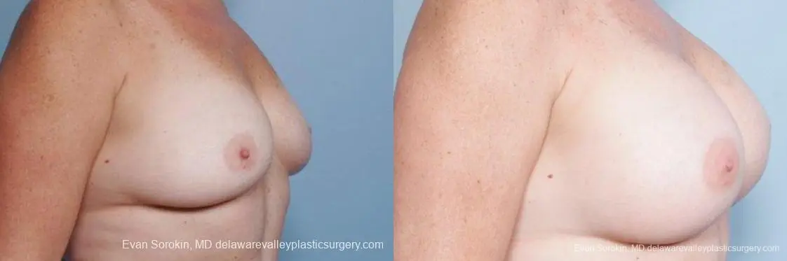 Philadelphia Breast Augmentation 9316 - Before and After 2