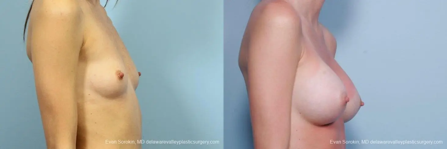 Philadelphia Breast Augmentation 8660 - Before and After 4