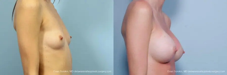 Philadelphia Breast Augmentation 8660 - Before and After 4