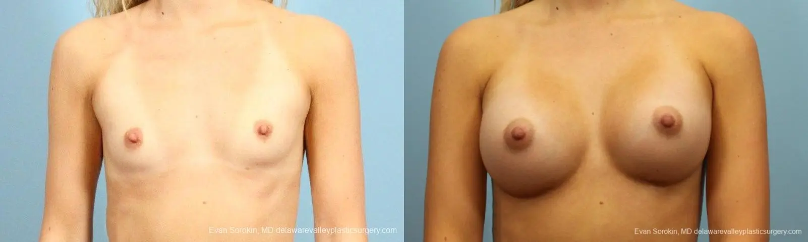 Philadelphia Breast Augmentation 9409 - Before and After 1