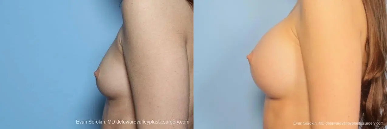 Philadelphia Breast Augmentation 8771 - Before and After 5