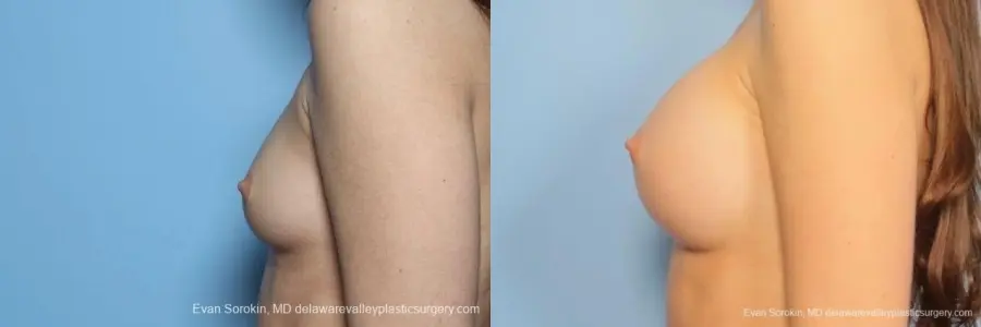 Philadelphia Breast Augmentation 8771 - Before and After 5