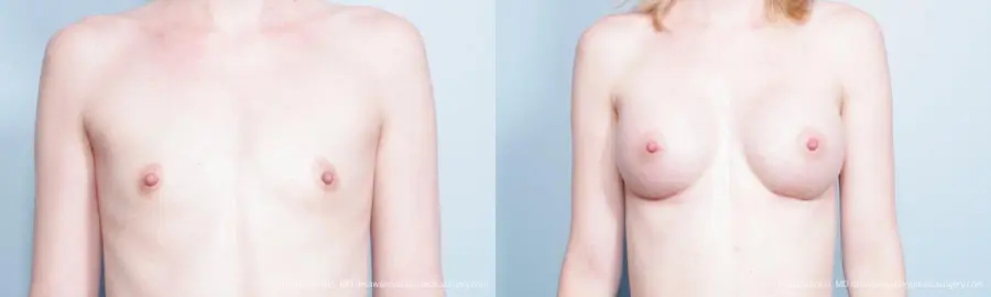 Philadelphia Breast Augmentation 9300 - Before and After 1