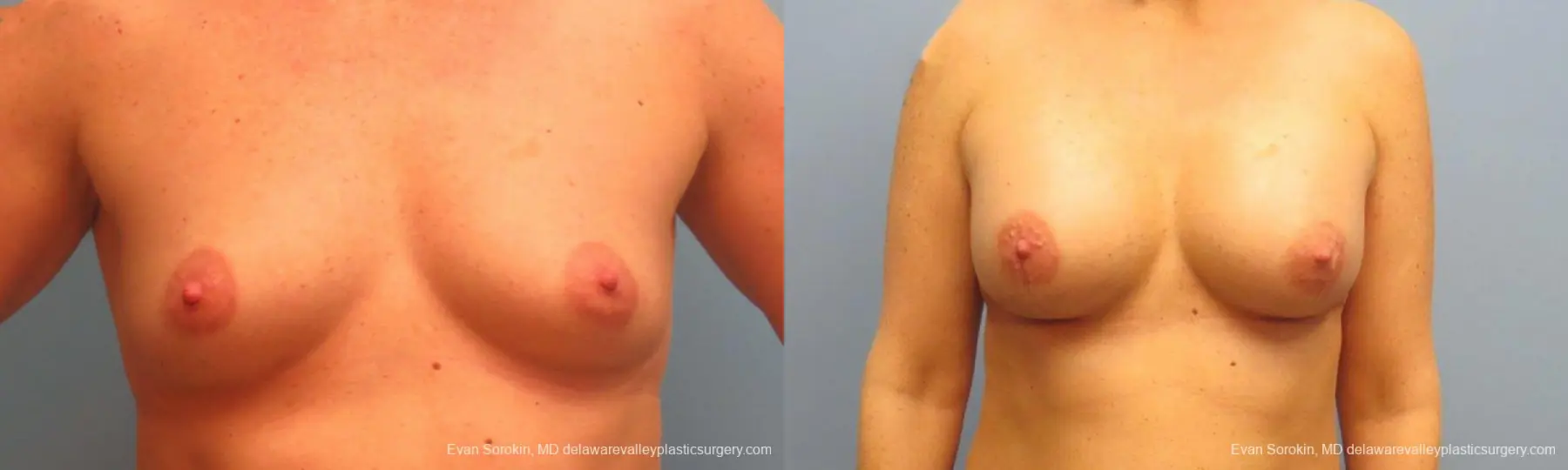 Philadelphia Breast Augmentation 9487 - Before and After 1