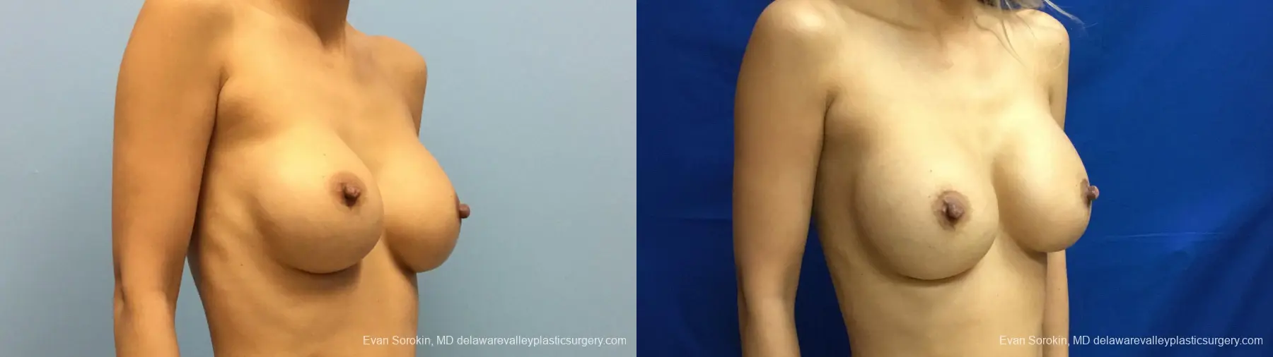 Philadelphia Breast Augmentation 13178 - Before and After 2