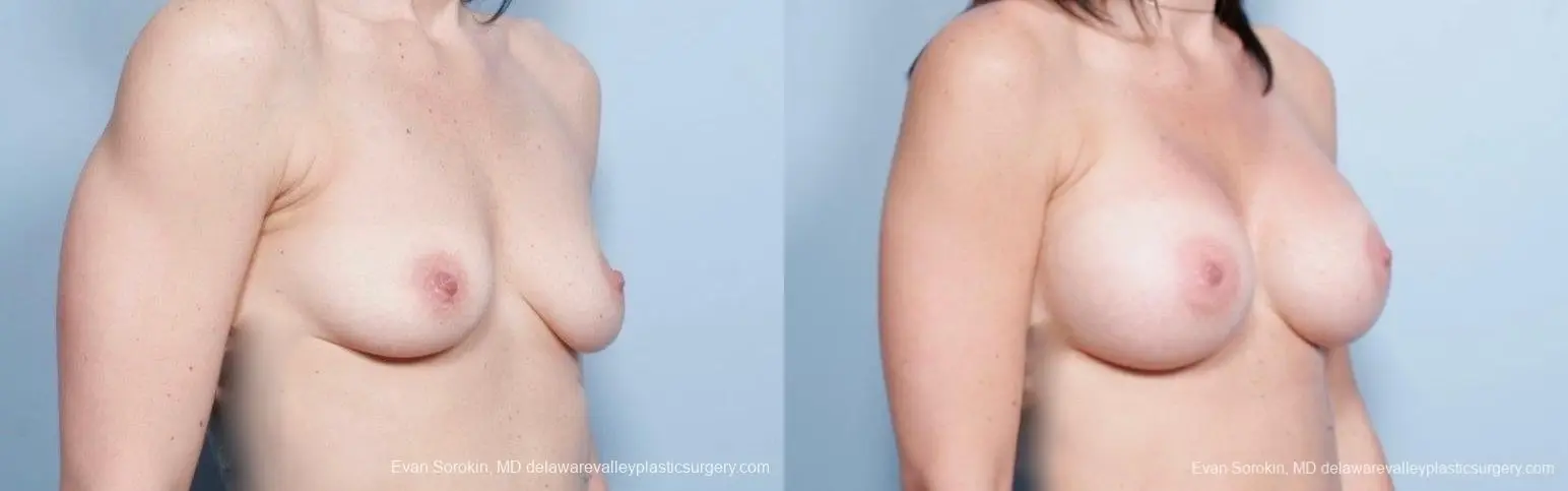 Philadelphia Breast Augmentation 8783 - Before and After 2