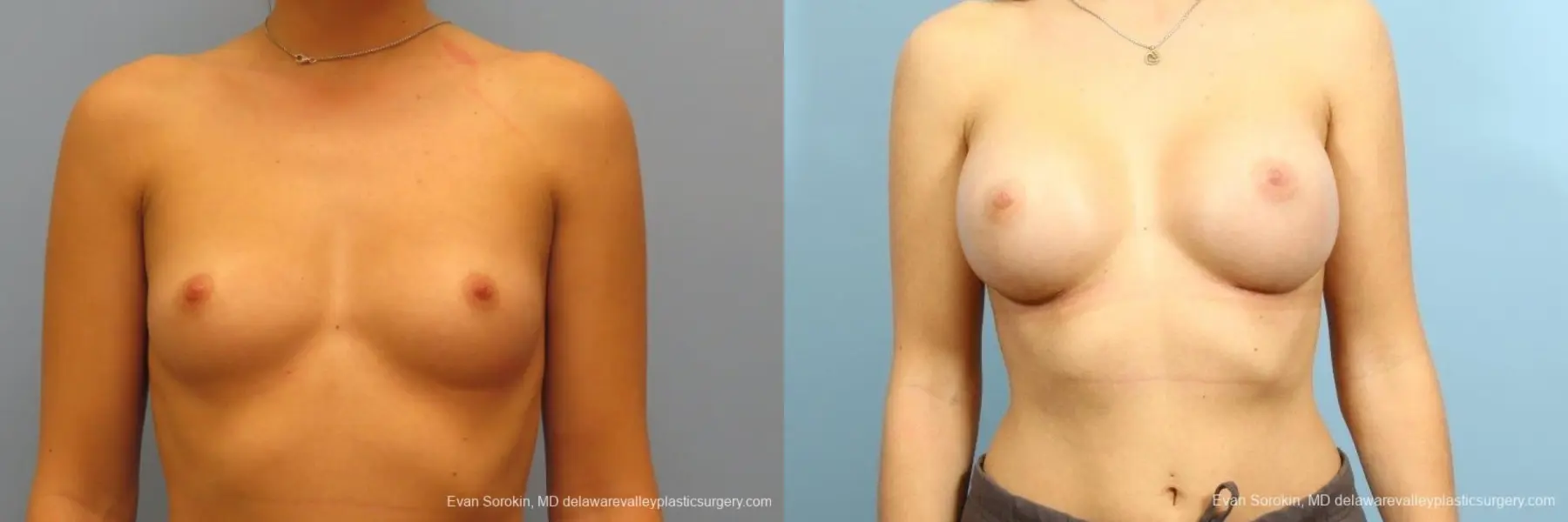 Philadelphia Breast Augmentation 8666 - Before and After 1