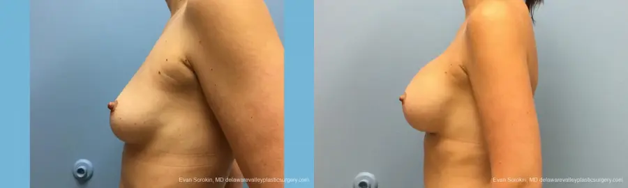 Philadelphia Breast Augmentation 12514 - Before and After 5