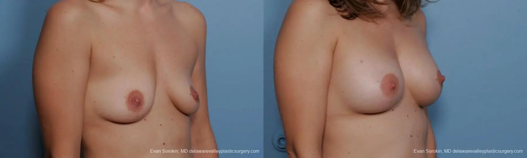 Philadelphia Breast Augmentation 9360 - Before and After 2