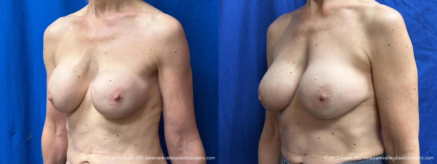 Breast Augmentation Revision: Patient 51 - Before and After 3