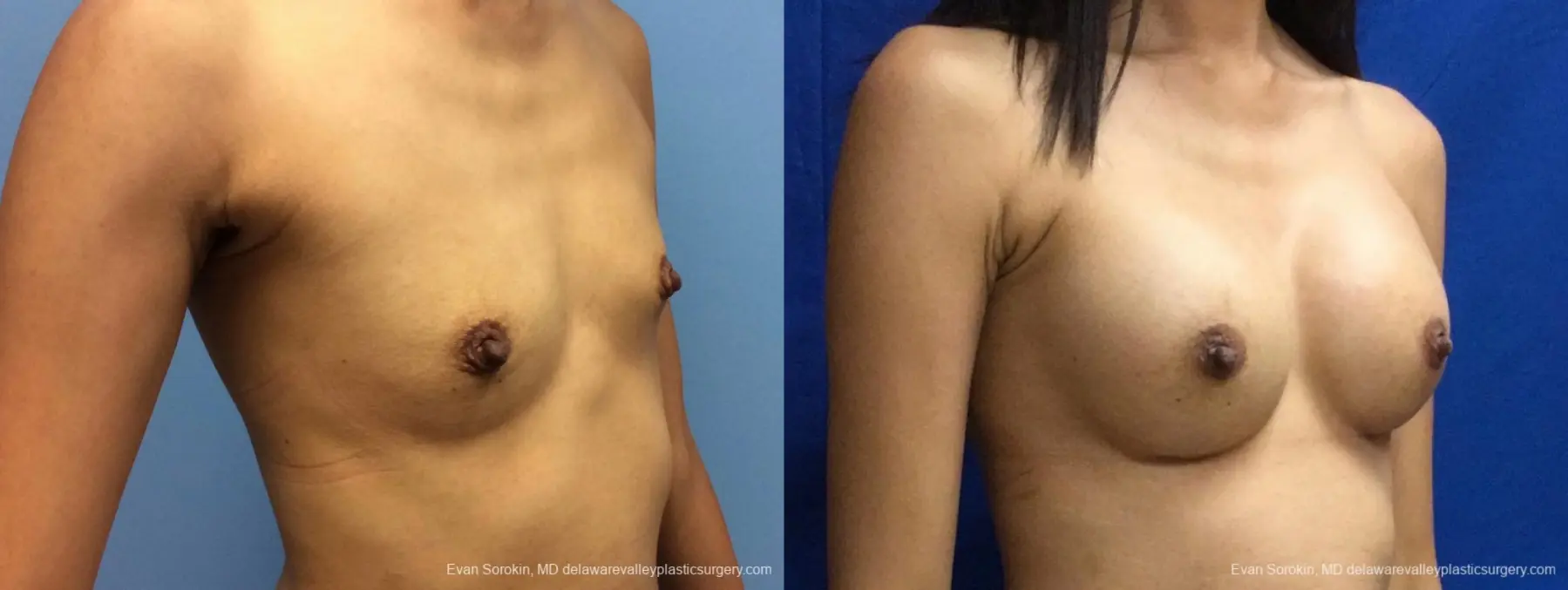 Philadelphia Breast Augmentation 13071 - Before and After 2