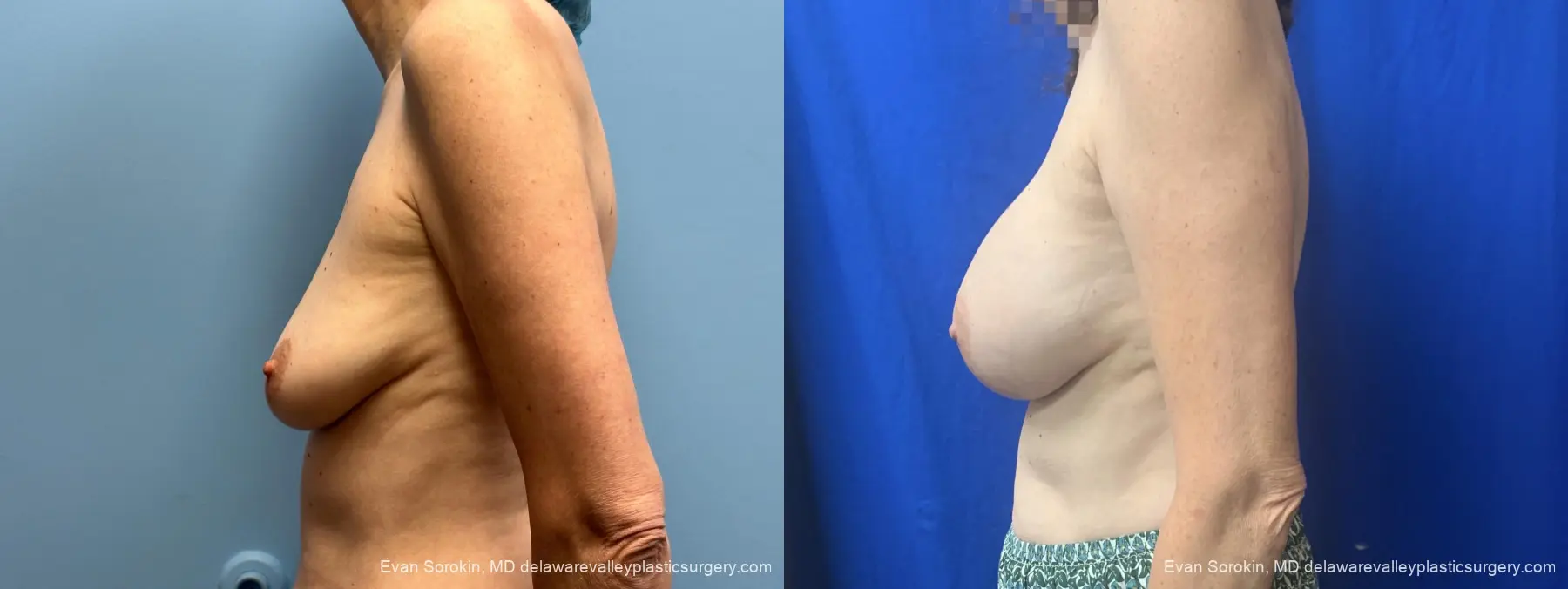 Breast Augmentation: Patient 328 - Before and After 5