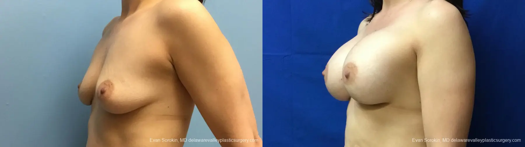 Philadelphia Breast Augmentation 12541 - Before and After 3