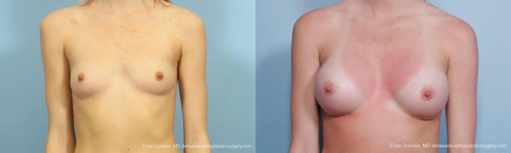 Philadelphia Breast Augmentation 8660 - Before and After 1