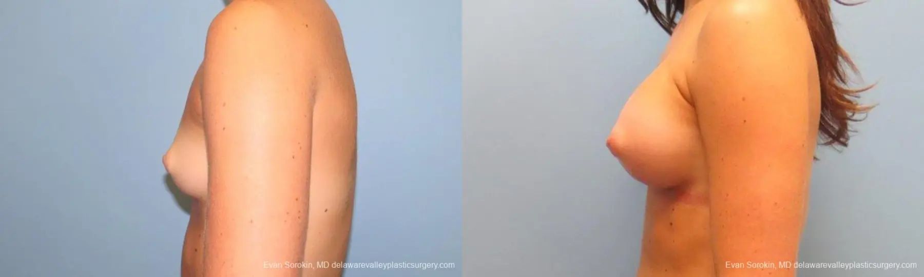 Philadelphia Breast Augmentation 9621 - Before and After 5
