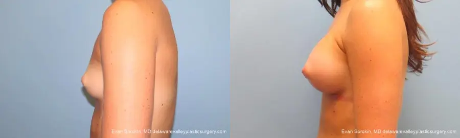 Philadelphia Breast Augmentation 9621 - Before and After 5