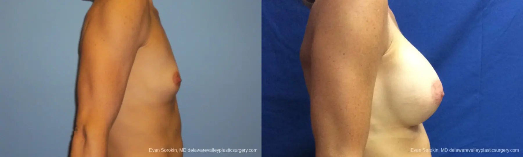 Philadelphia Breast Augmentation 10248 - Before and After 3