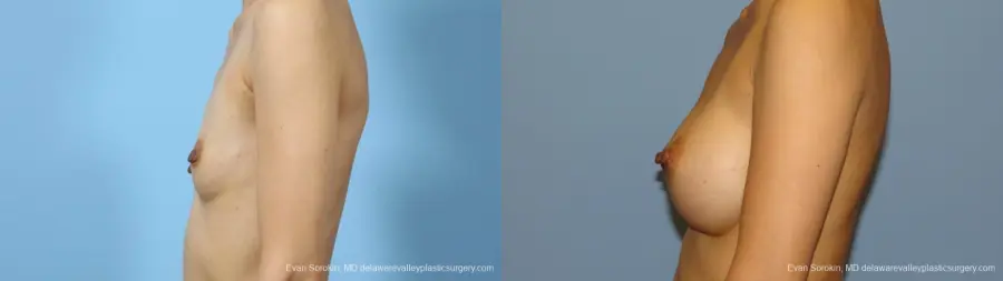 Philadelphia Breast Augmentation 9291 - Before and After 5