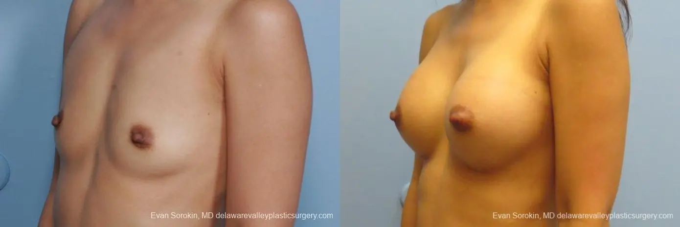 Philadelphia Breast Augmentation 8661 - Before and After 3