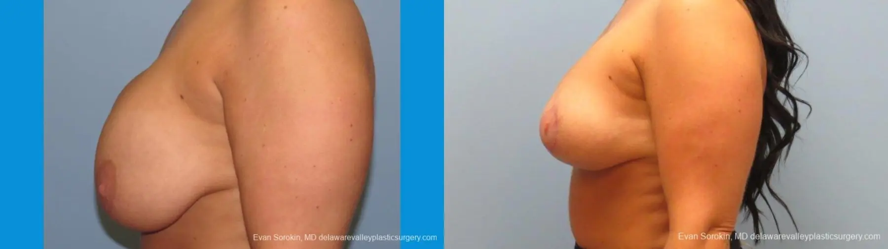 Philadelphia Breast Augmentation 10089 - Before and After 5