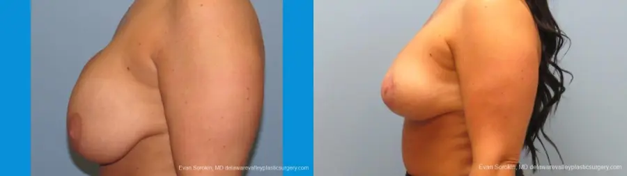 Philadelphia Breast Augmentation 10089 - Before and After 5