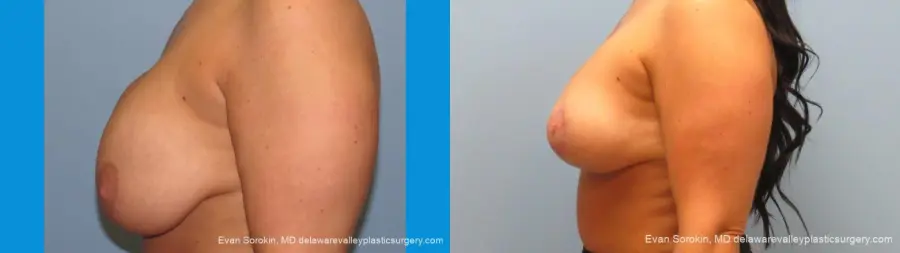 Philadelphia Breast Augmentation 10089 - Before and After 5