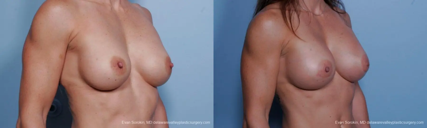 Philadelphia Breast Augmentation 9455 - Before and After 2