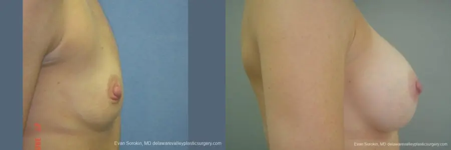 Philadelphia Breast Augmentation 9403 - Before and After 3
