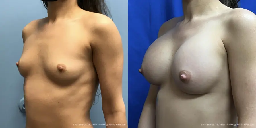 Breast Augmentation: Patient 197 - Before and After 4