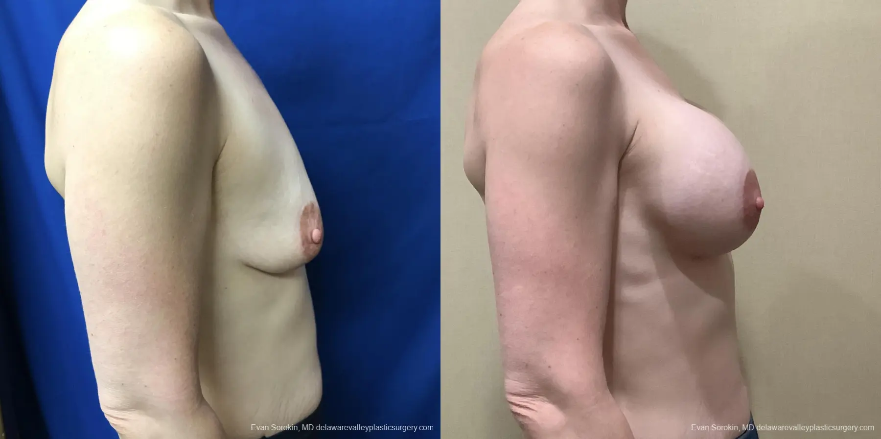 Breast Augmentation: Patient 217 - Before and After 3