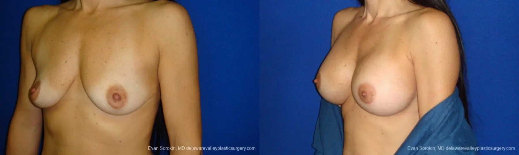 Philadelphia Breast Augmentation 9413 - Before and After 4
