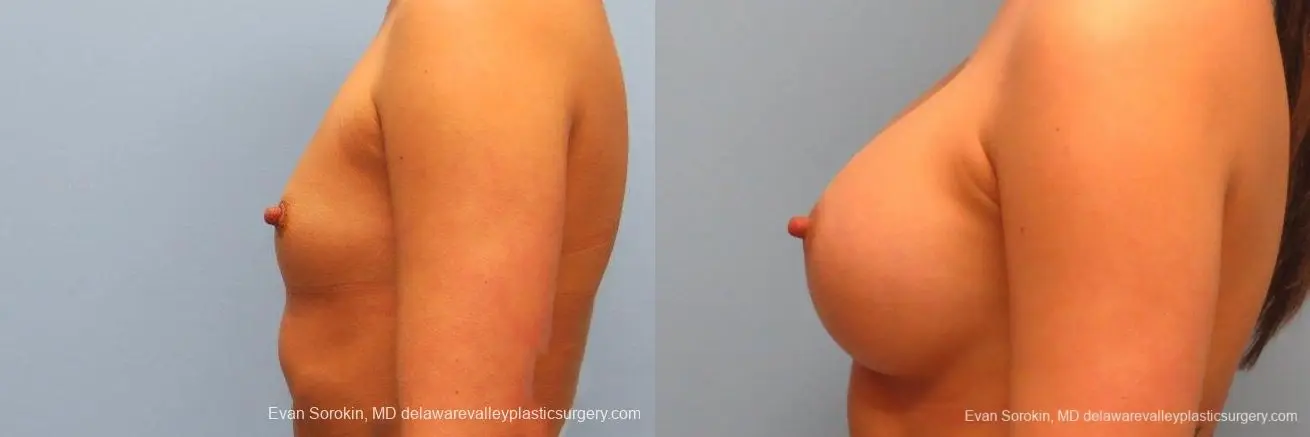 Philadelphia Breast Augmentation 9410 - Before and After 5