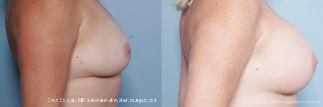 Philadelphia Breast Augmentation 9316 - Before and After 3