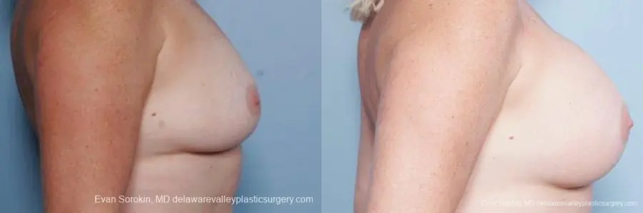 Philadelphia Breast Augmentation 9316 - Before and After 3