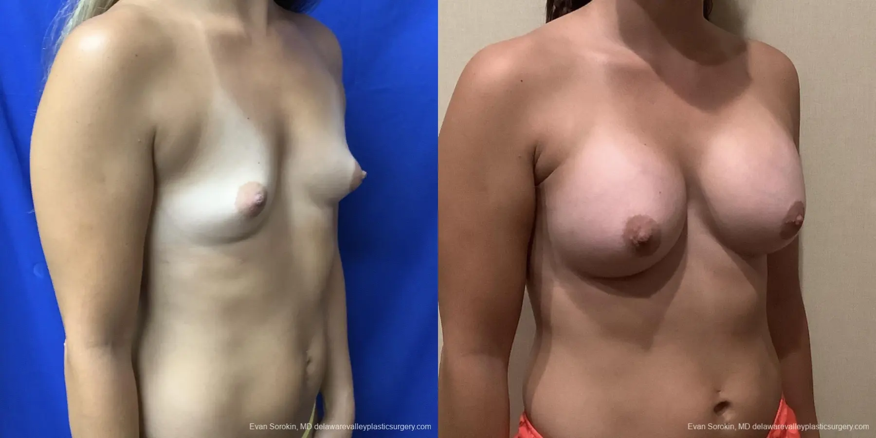 Breast Augmentation: Patient 185 - Before and After 2