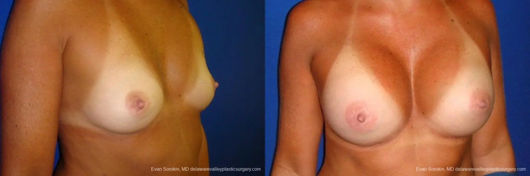 Philadelphia Breast Augmentation 8775 - Before and After 2