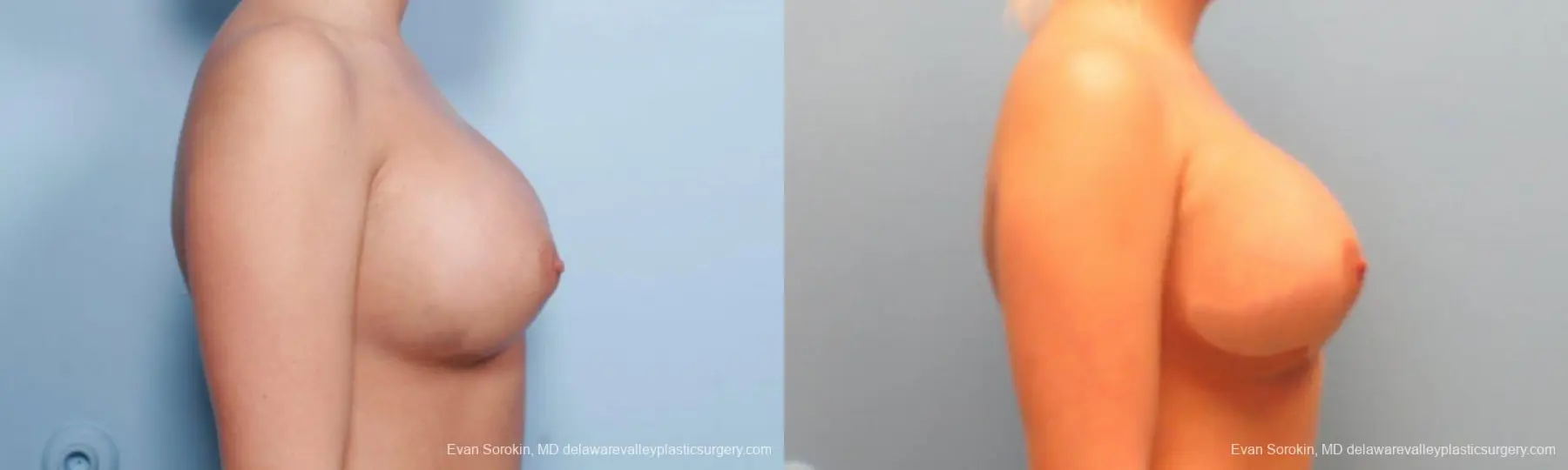 Philadelphia Breast Augmentation 9394 - Before and After 3