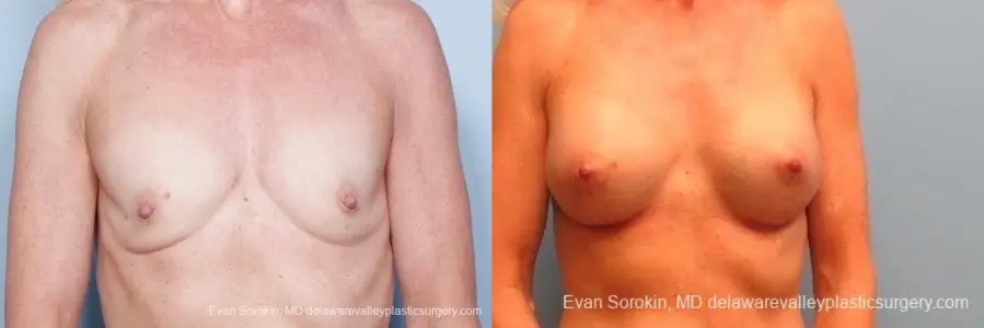 Philadelphia Breast Augmentation 8770 - Before and After 1