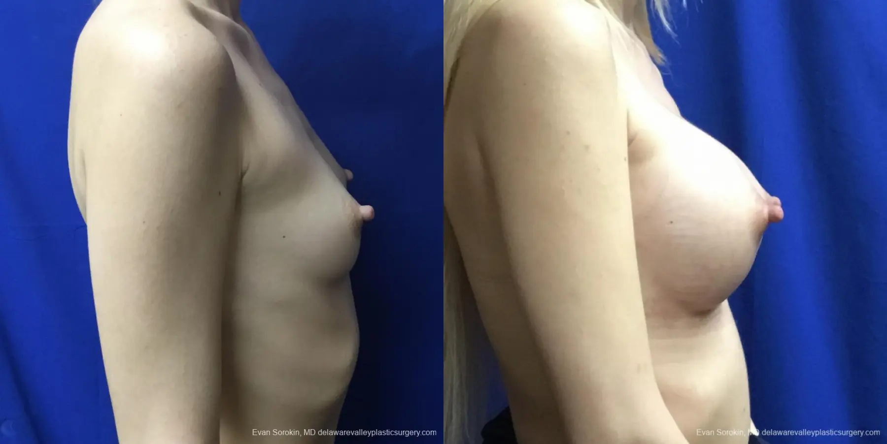 Breast Augmentation: Patient 167 - Before and After 3