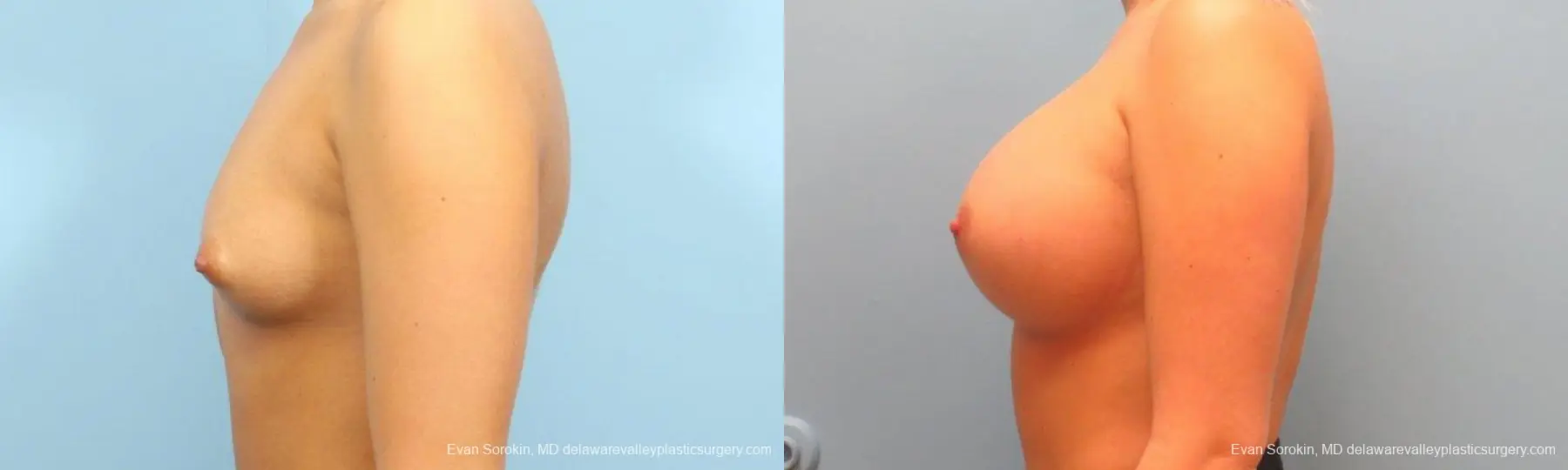 Philadelphia Breast Augmentation 9393 - Before and After 5