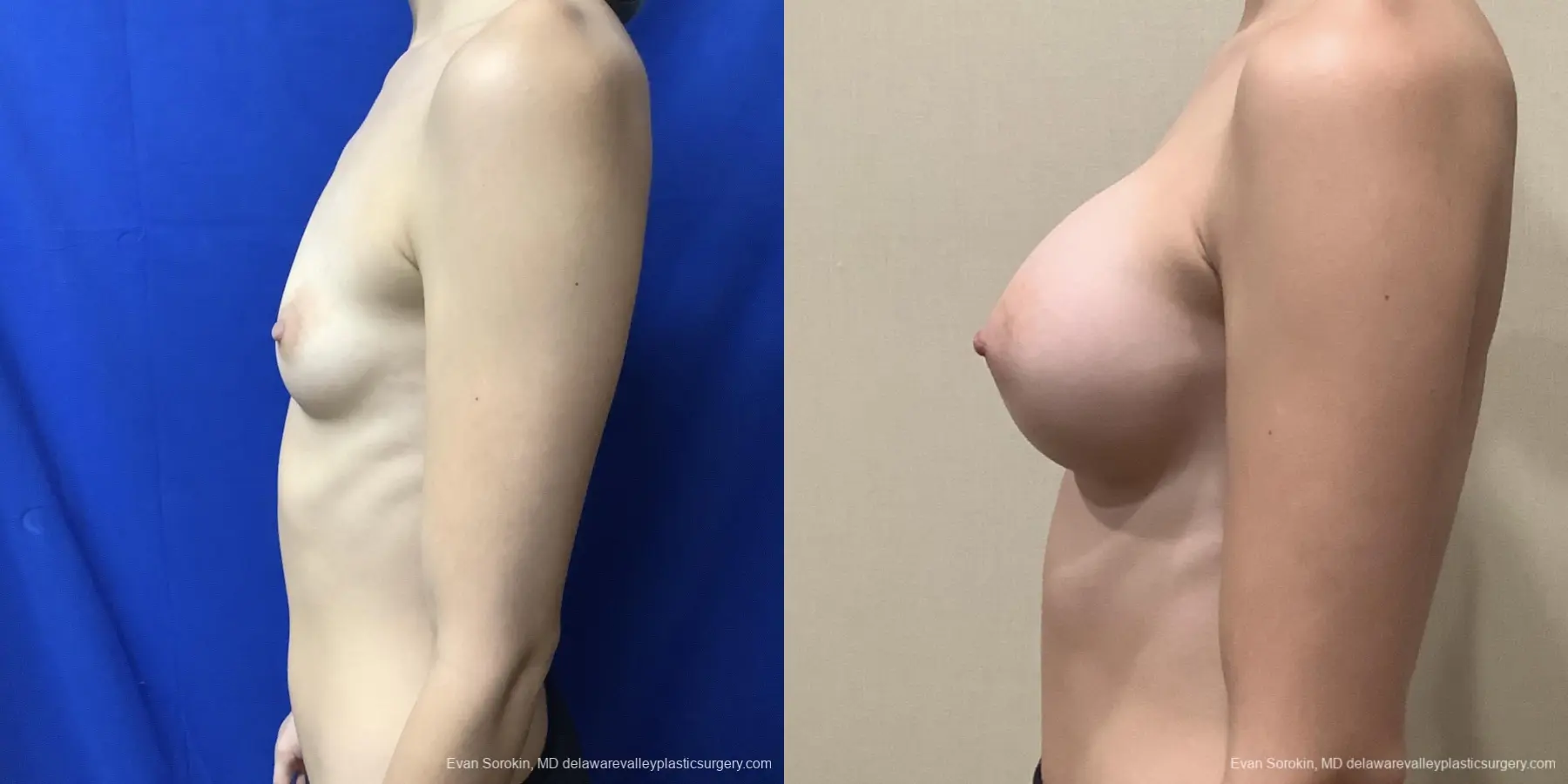 Breast Augmentation: Patient 210 - Before and After 5