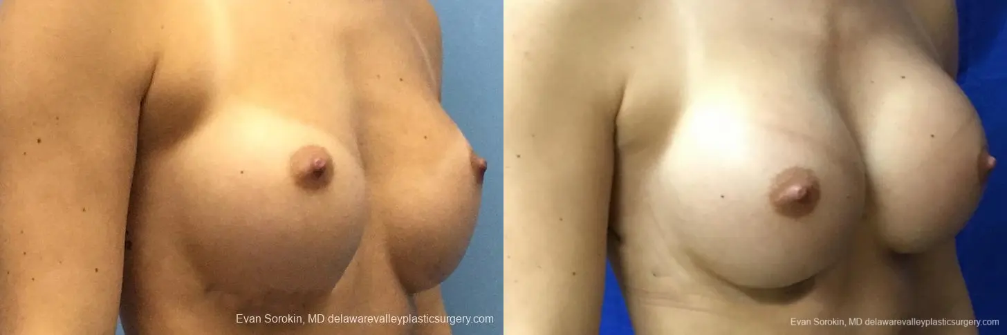 Philadelphia Breast Augmentation 10816 - Before and After 2