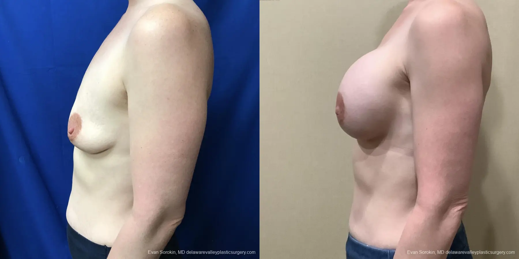 Breast Augmentation: Patient 217 - Before and After 5