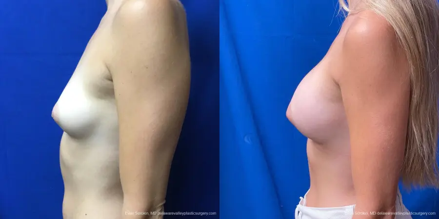 Breast Augmentation: Patient 171 - Before and After 5