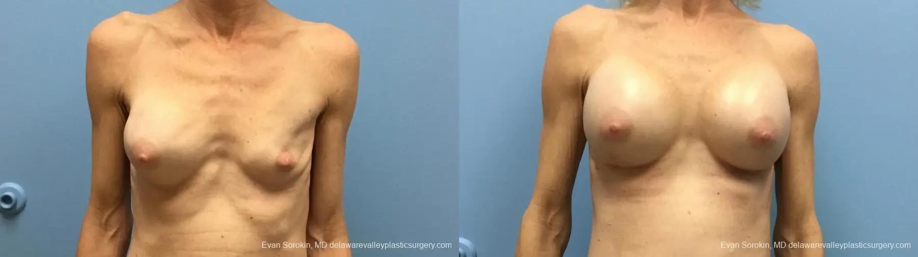 Philadelphia Breast Augmentation 13182 - Before and After 1