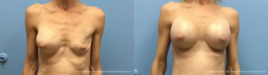 Philadelphia Breast Augmentation 13182 - Before and After 1