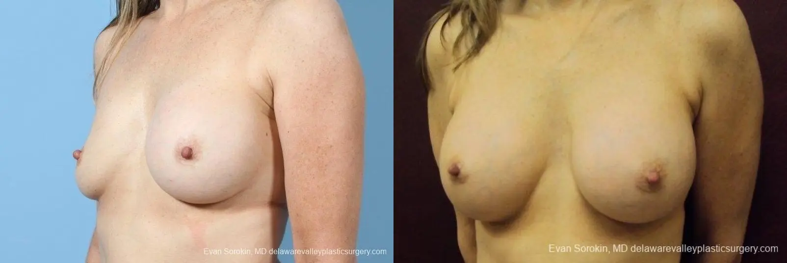 Philadelphia Breast Augmentation 8708 - Before and After 3