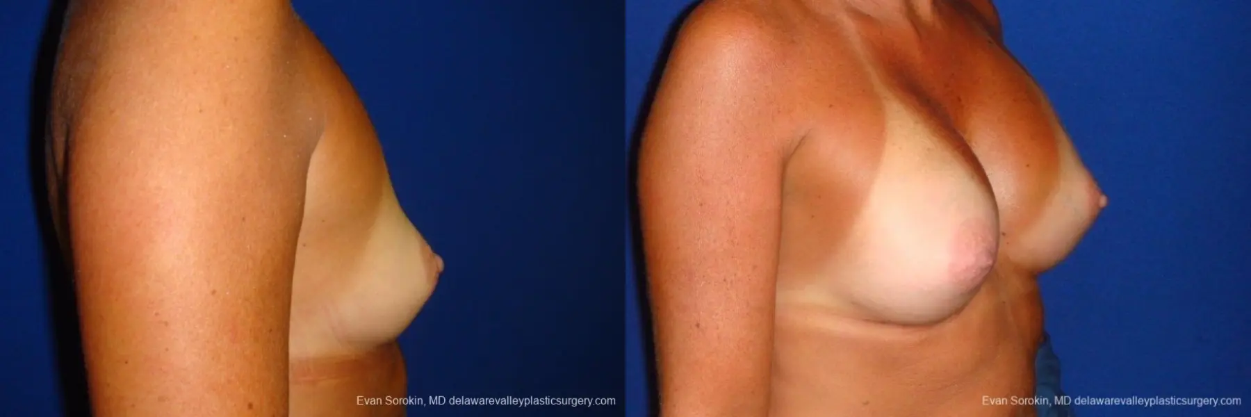 Philadelphia Breast Augmentation 8775 - Before and After 4